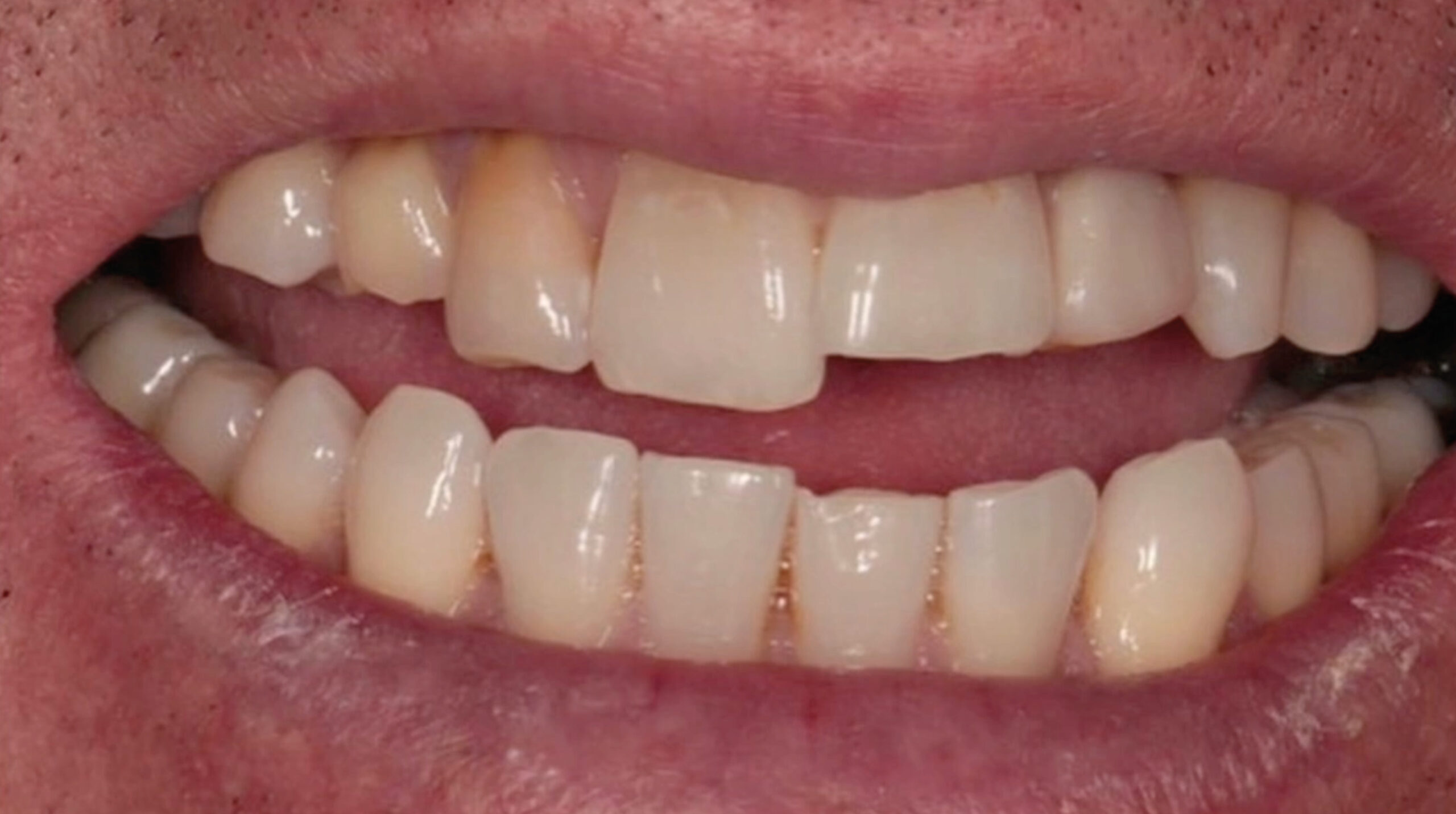 Second Day_TrioClear Align and Restore_Slider_2