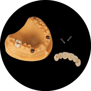 Anterior implant crown Kopie (1)