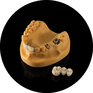 Implant-supported dental bridge (1)