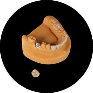 Posterior implant crown (1)